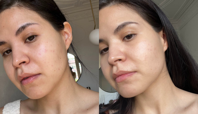 Niacinamide & Salicylic Acid For Breakout-Prone Skin