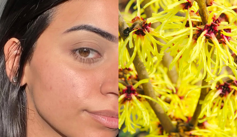 Top Witch Hazel Skin Benefits & How to Use It